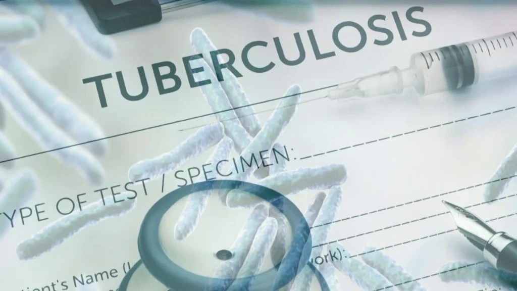 Tuberculosis Outbreak in Kansas Raises Public Health Concerns